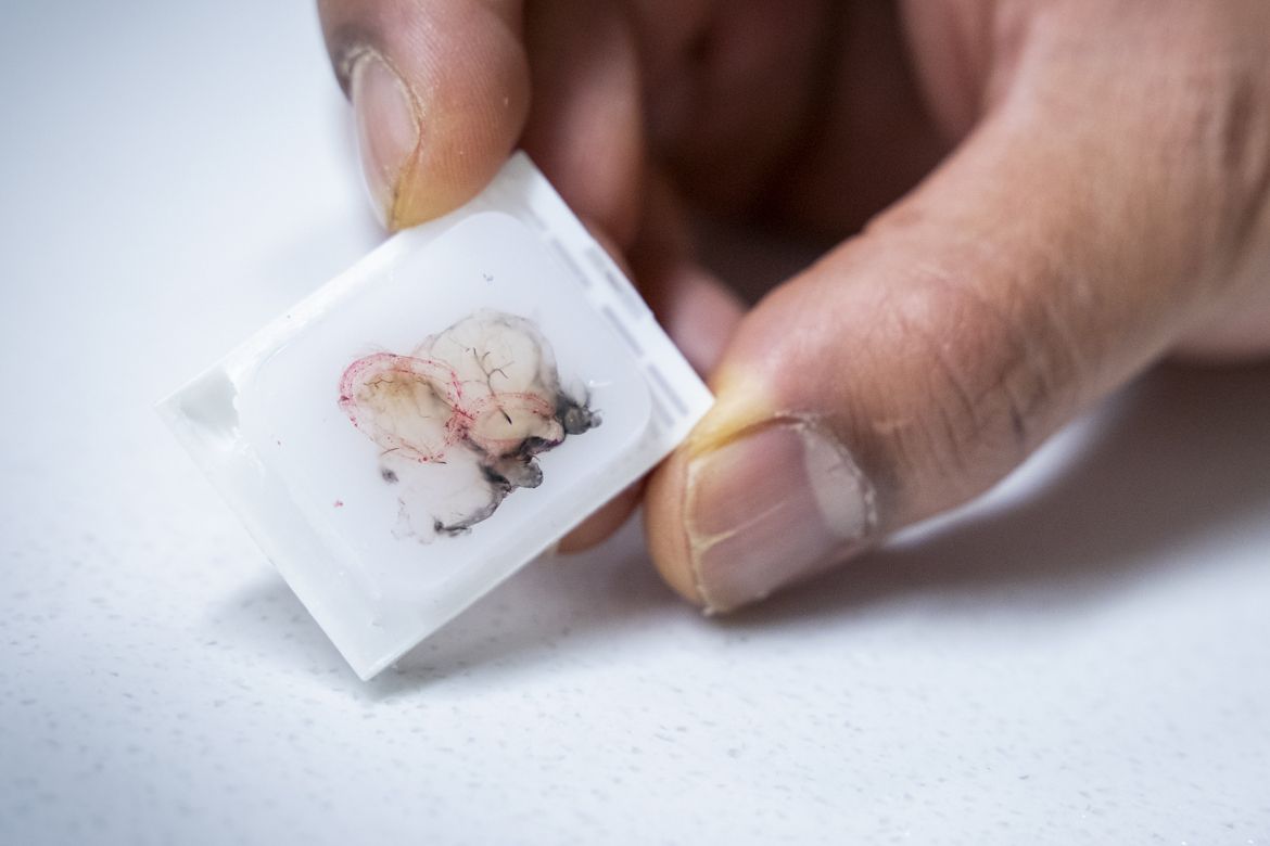Tumour sample preserved in parrafin