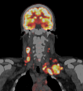 High-sensitivity PET scan fused with low-dose CT scan.